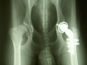 protesi all'anca